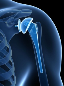 эндопротезирования плечевого сустава